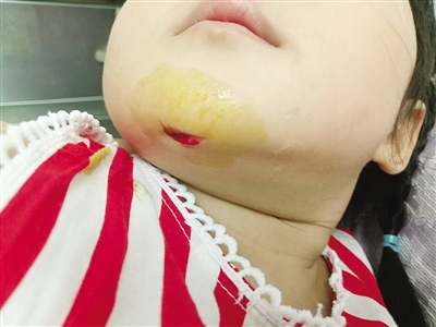 海南特区报数字报-两岁女童幼儿园磕伤下巴